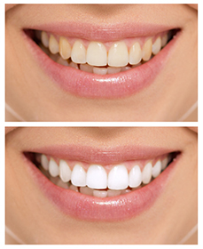 Tooth Whitening in San Diego